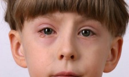 Cara Mengatasi Iritasi Mata Pada Anak